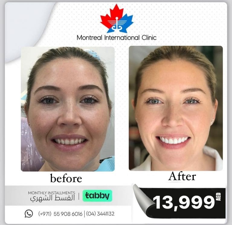 Before and after veneers case 2