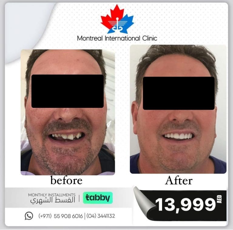 Before and after veneers case 3