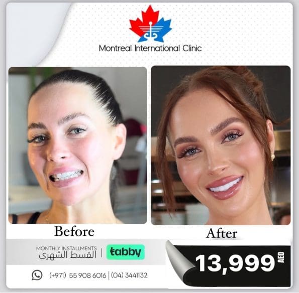 Before and after veneers case 3